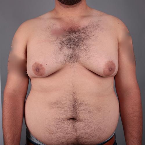 Gynecomastia Surgery Before & After Image