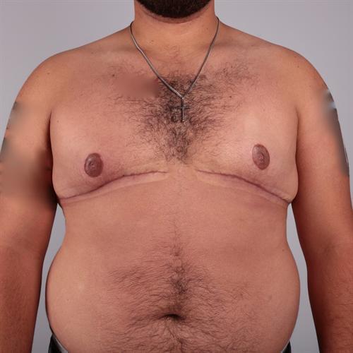 Gynecomastia Surgery Before & After Image