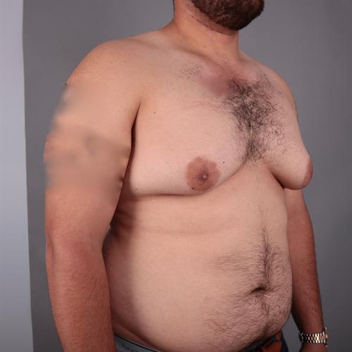 Gynecomastia Surgery Before & After Image