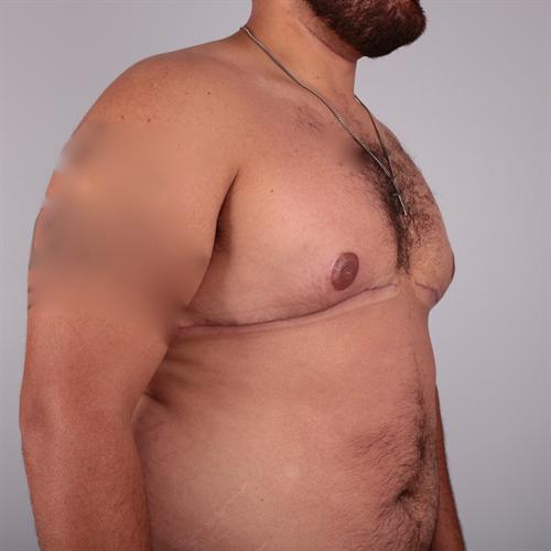 Gynecomastia Surgery Before & After Image