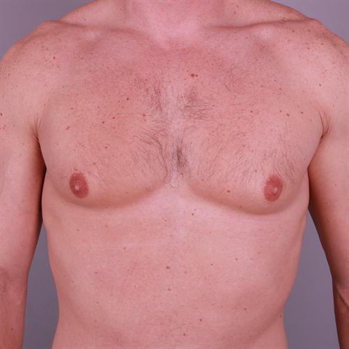 Gynecomastia Surgery Before & After Image