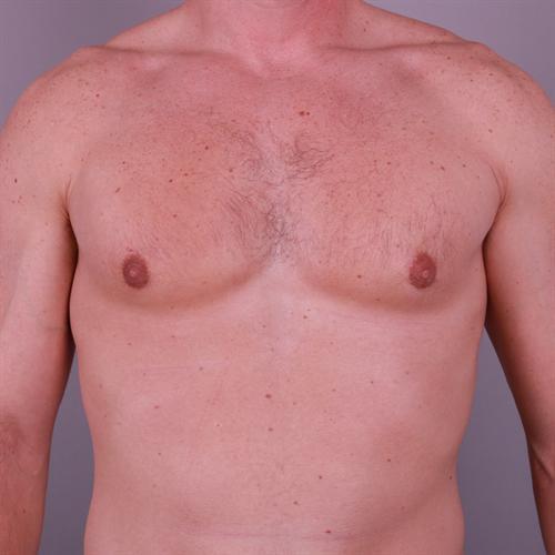 Gynecomastia Surgery Before & After Image