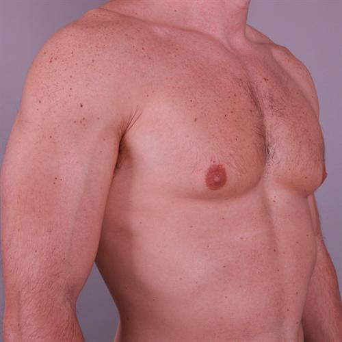 Gynecomastia Surgery Before & After Image