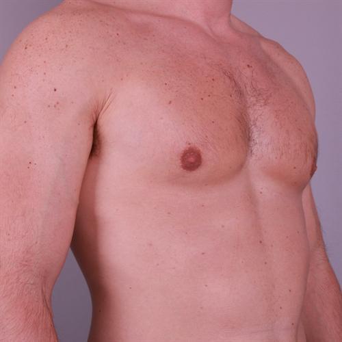 Gynecomastia Surgery Before & After Image