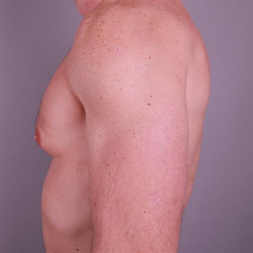 Gynecomastia Surgery Before & After Image