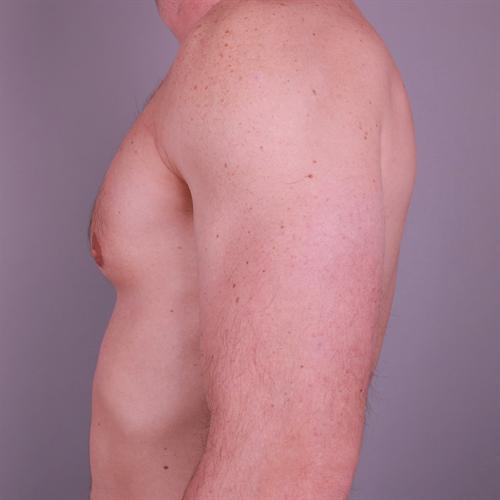 Gynecomastia Surgery Before & After Image