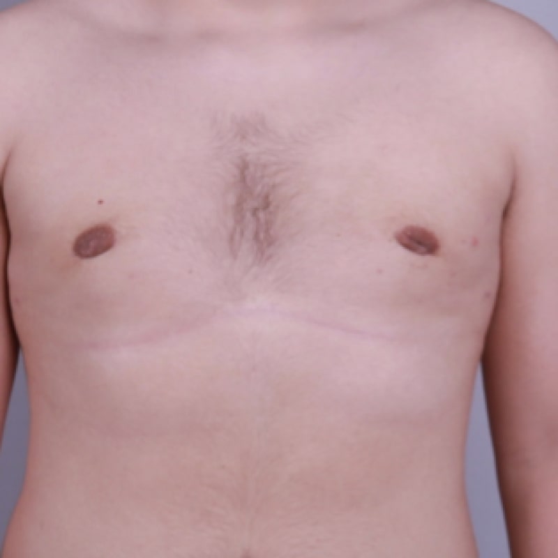Gynecomastia Surgery Before & After Image