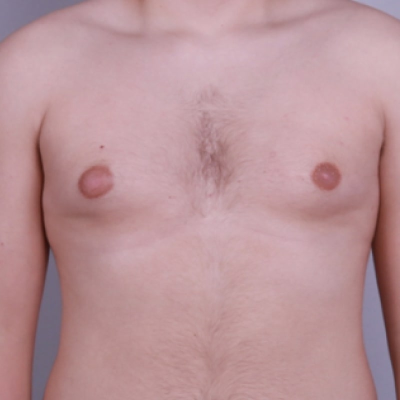 Gynecomastia Surgery Before & After Image