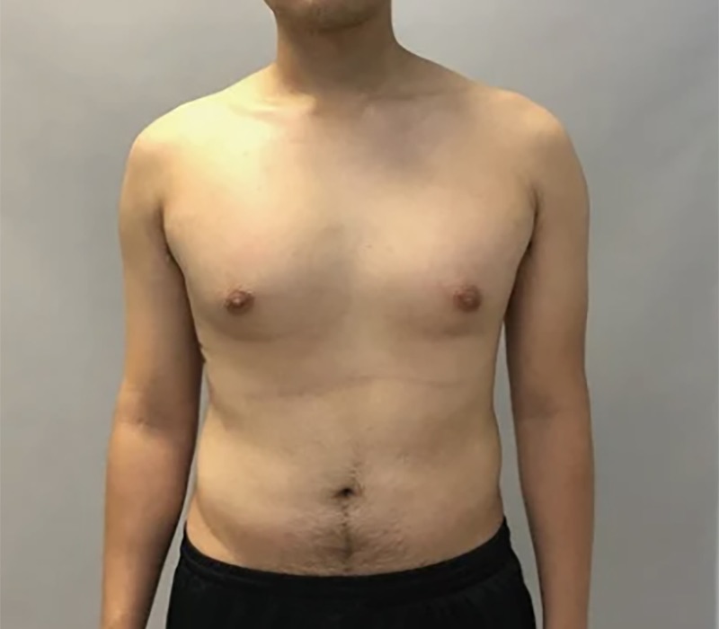 Gynecomastia Surgery Before & After Image