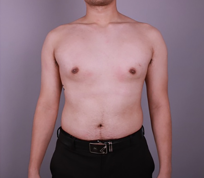 Gynecomastia Surgery Before & After Image