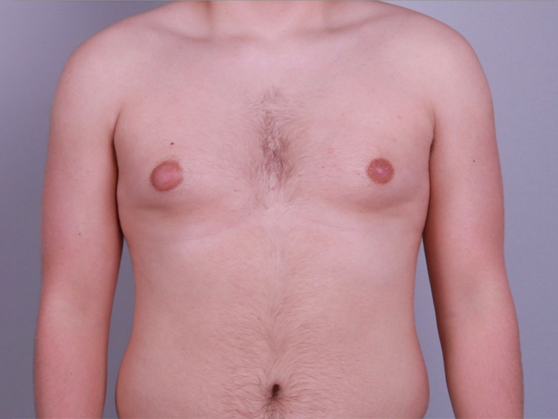 Gynecomastia Surgery Before & After Image