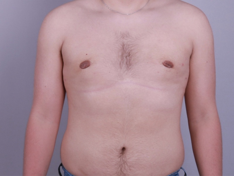 Gynecomastia Surgery Before & After Image