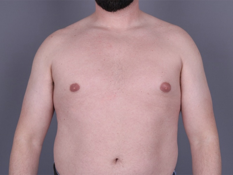 Gynecomastia Surgery Before & After Image