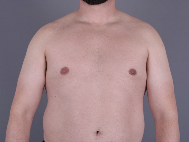 Gynecomastia Surgery Before & After Image