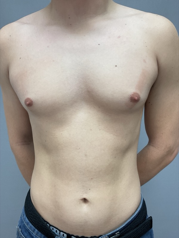 Gynecomastia Surgery Before & After Image