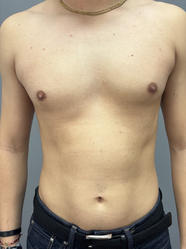 Gynecomastia Surgery Before & After Image