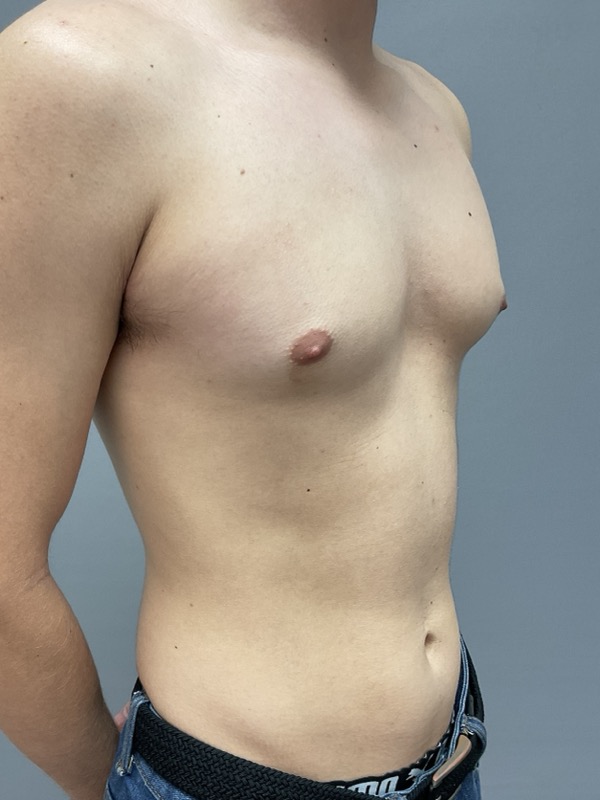 Gynecomastia Surgery Before & After Image