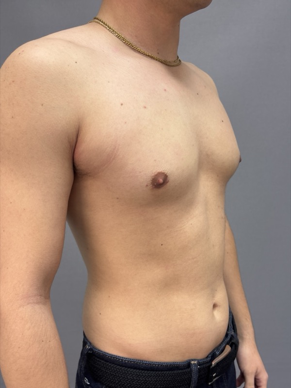 Gynecomastia Surgery Before & After Image