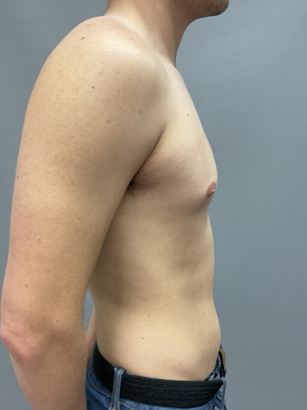 Gynecomastia Surgery Before & After Image