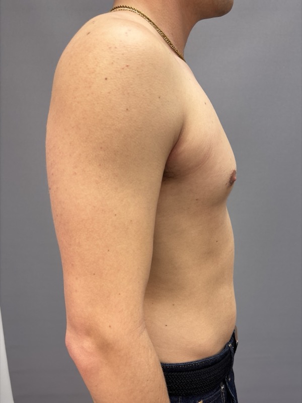 Gynecomastia Surgery Before & After Image