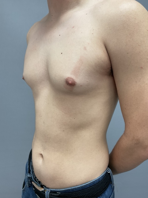 Gynecomastia Surgery Before & After Image