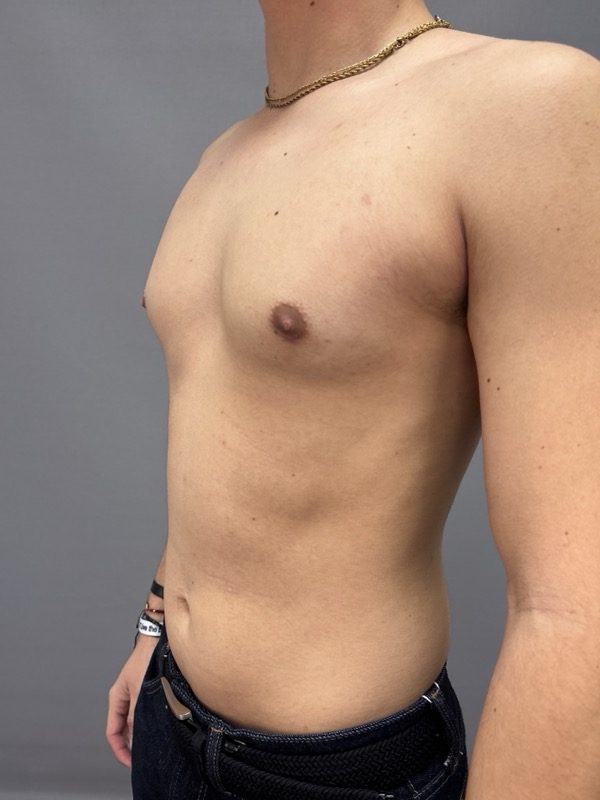 Gynecomastia Surgery Before & After Image