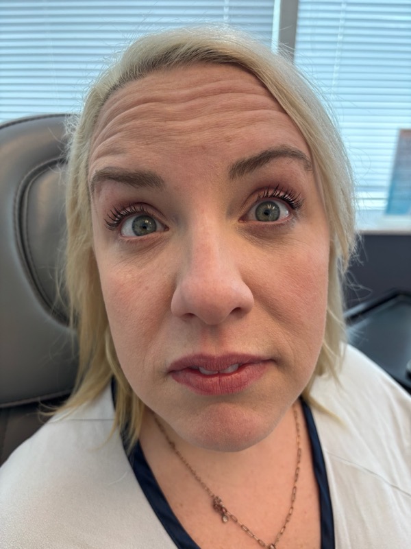 Botox Before & After Image