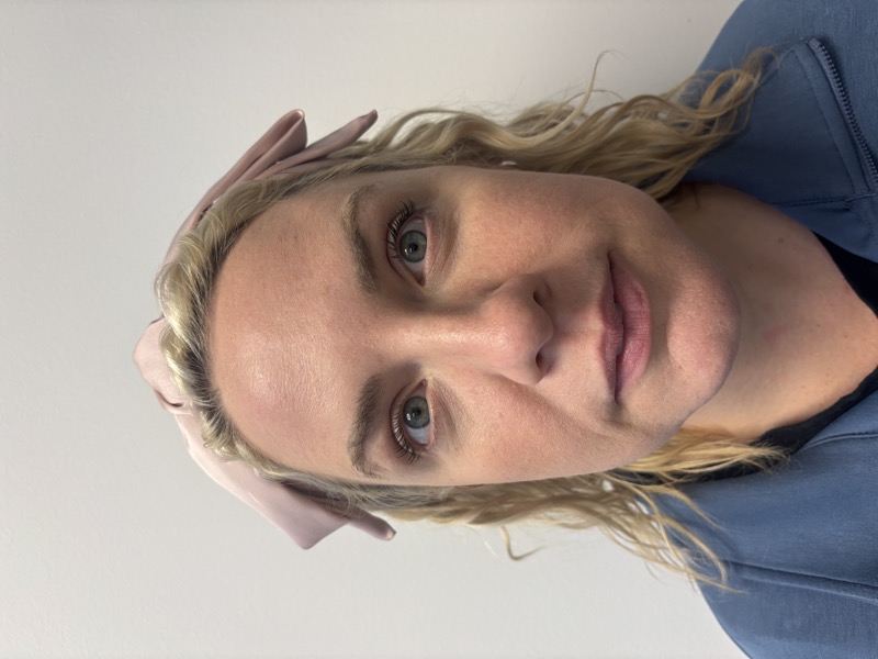 Botox Before & After Image