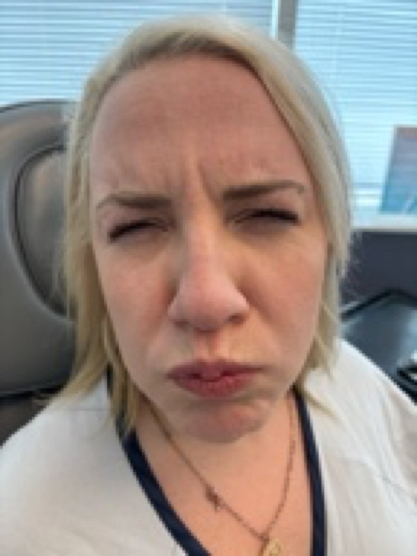 Botox Before & After Image
