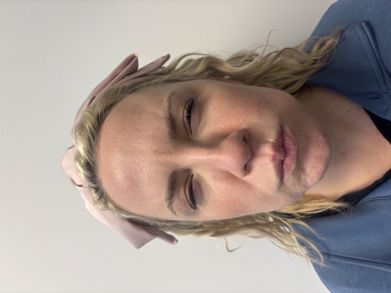 Botox Before & After Image