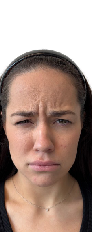 Botox Before & After Image