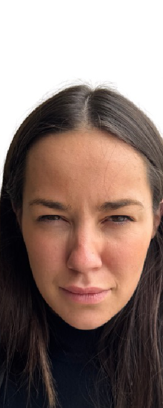 Botox Before & After Image