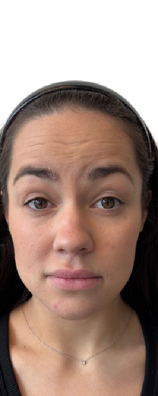 Botox Before & After Image