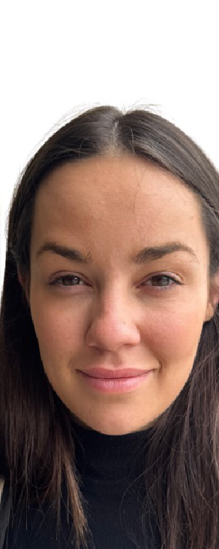 Botox Before & After Image