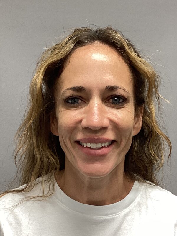 Botox Before & After Image