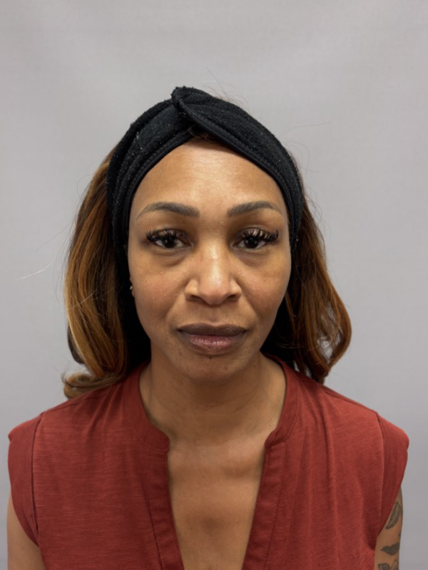 Cheek Filler Before & After Image