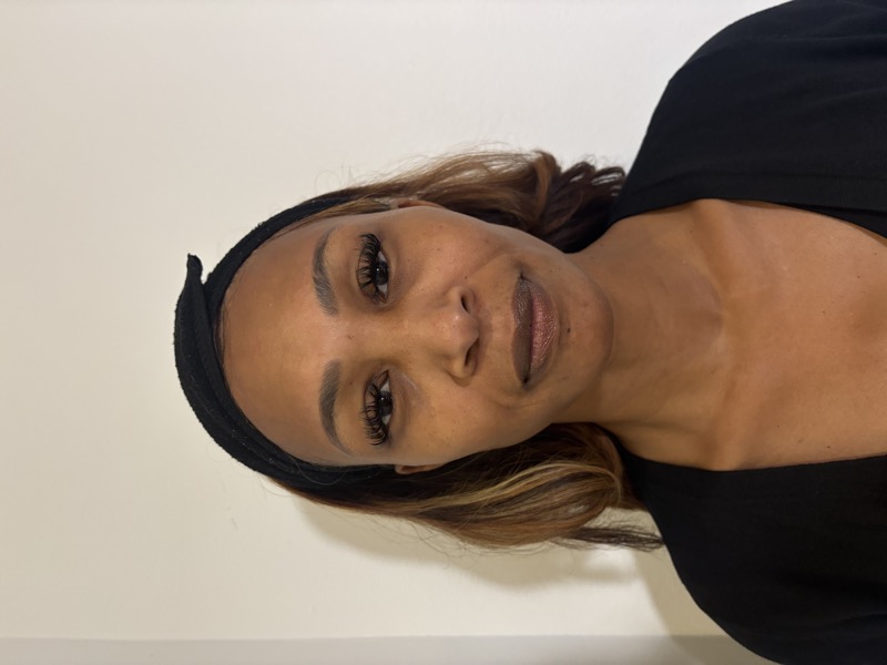 Cheek Filler Before & After Image