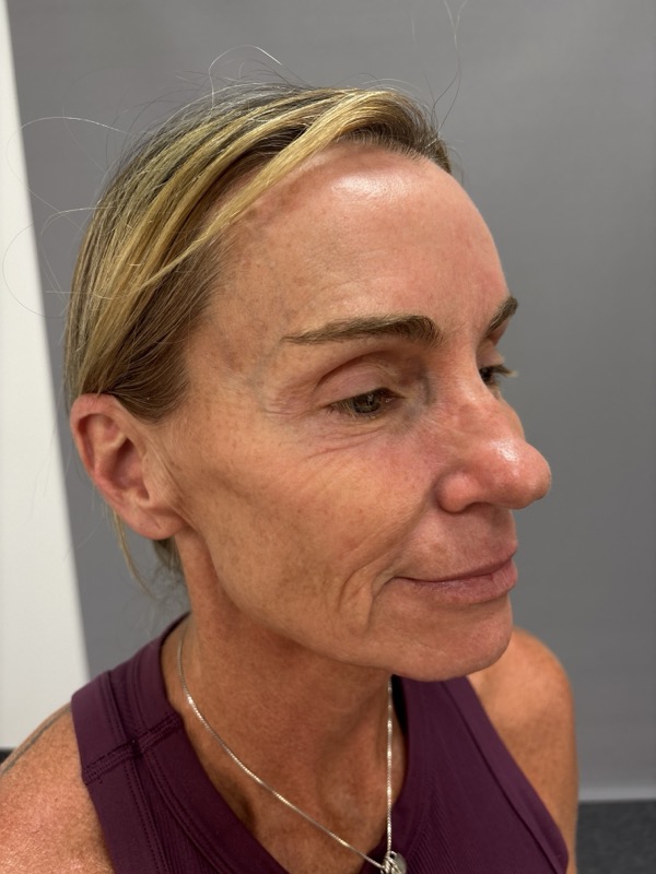 CO2 Laser Before & After Image