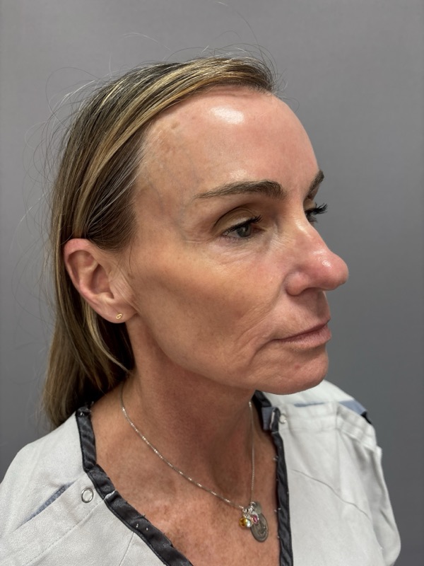 CO2 Laser Before & After Image