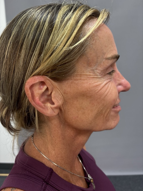 CO2 Laser Before & After Image