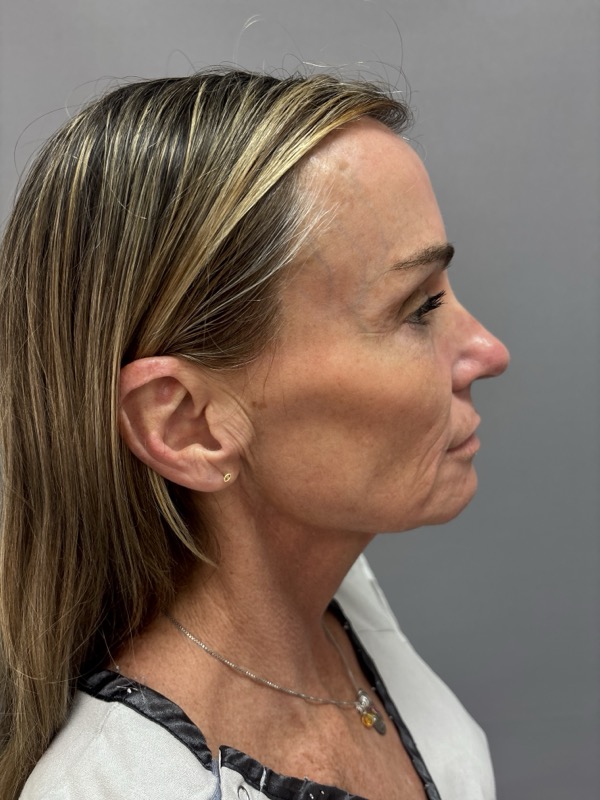 CO2 Laser Before & After Image