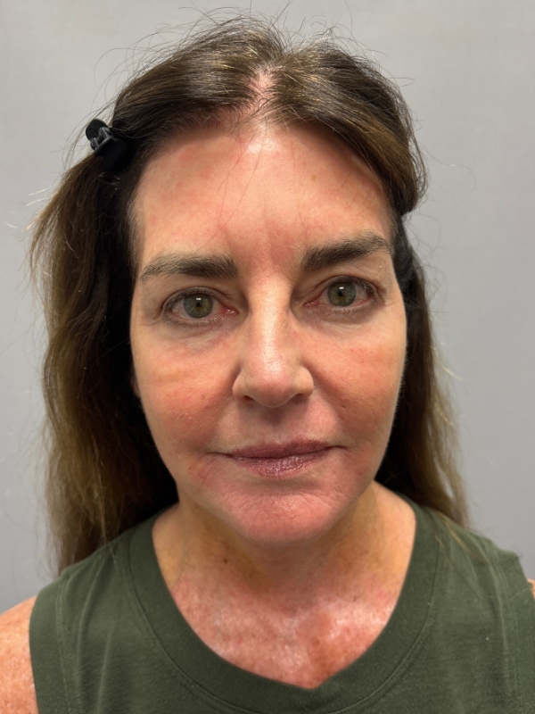 CO2 Laser Before & After Image