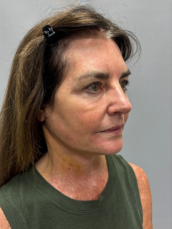 CO2 Laser Before & After Image