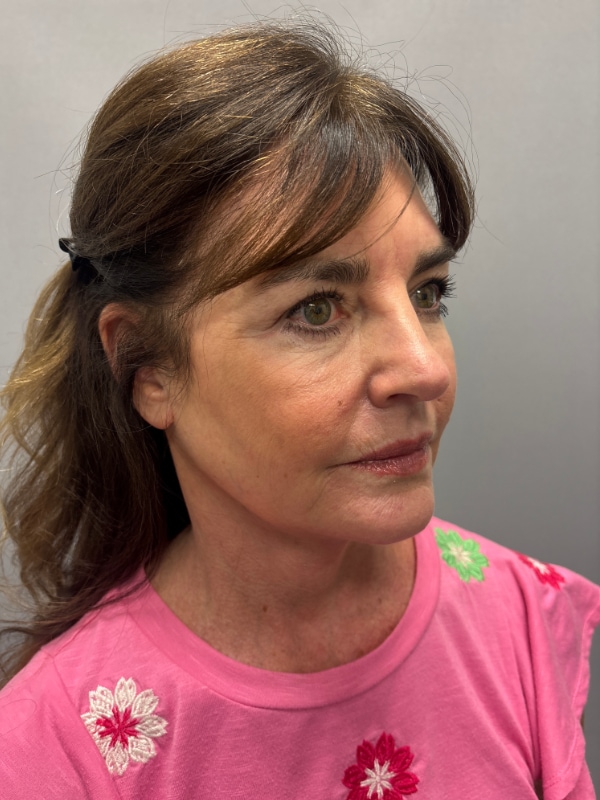 CO2 Laser Before & After Image