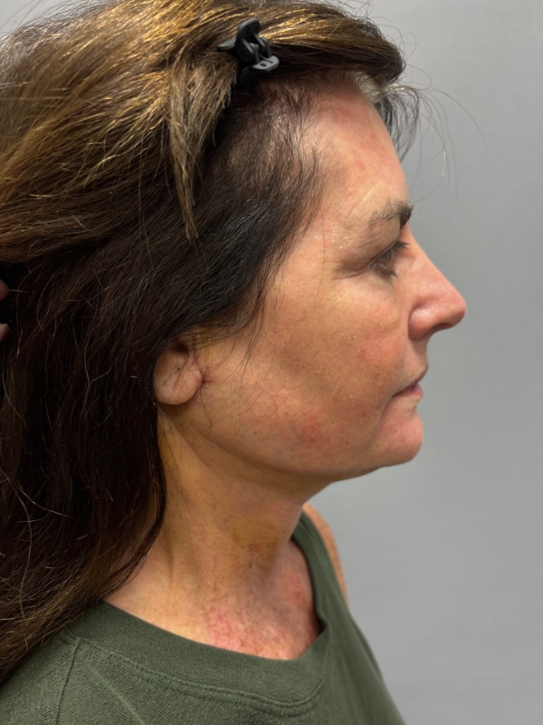 CO2 Laser Before & After Image