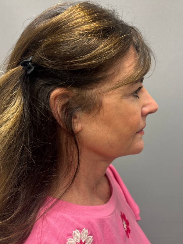 CO2 Laser Before & After Image