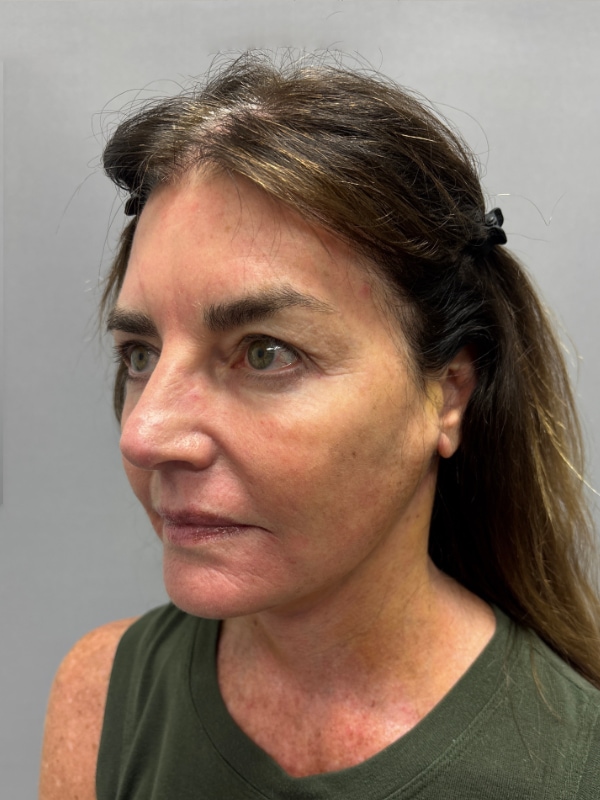 CO2 Laser Before & After Image