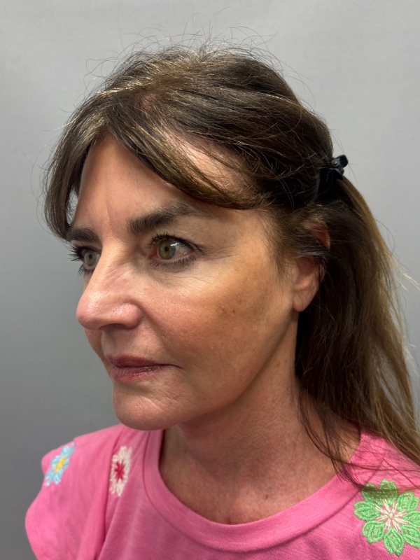 CO2 Laser Before & After Image