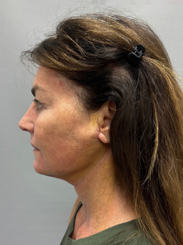 CO2 Laser Before & After Image