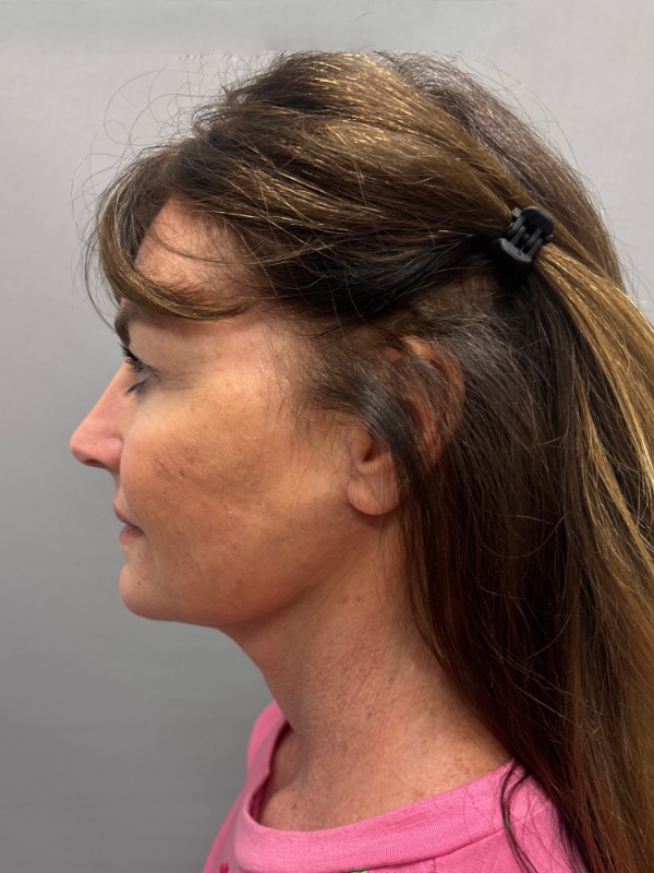 CO2 Laser Before & After Image